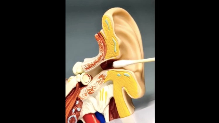 Never remove wax with ear&nbsp;buds